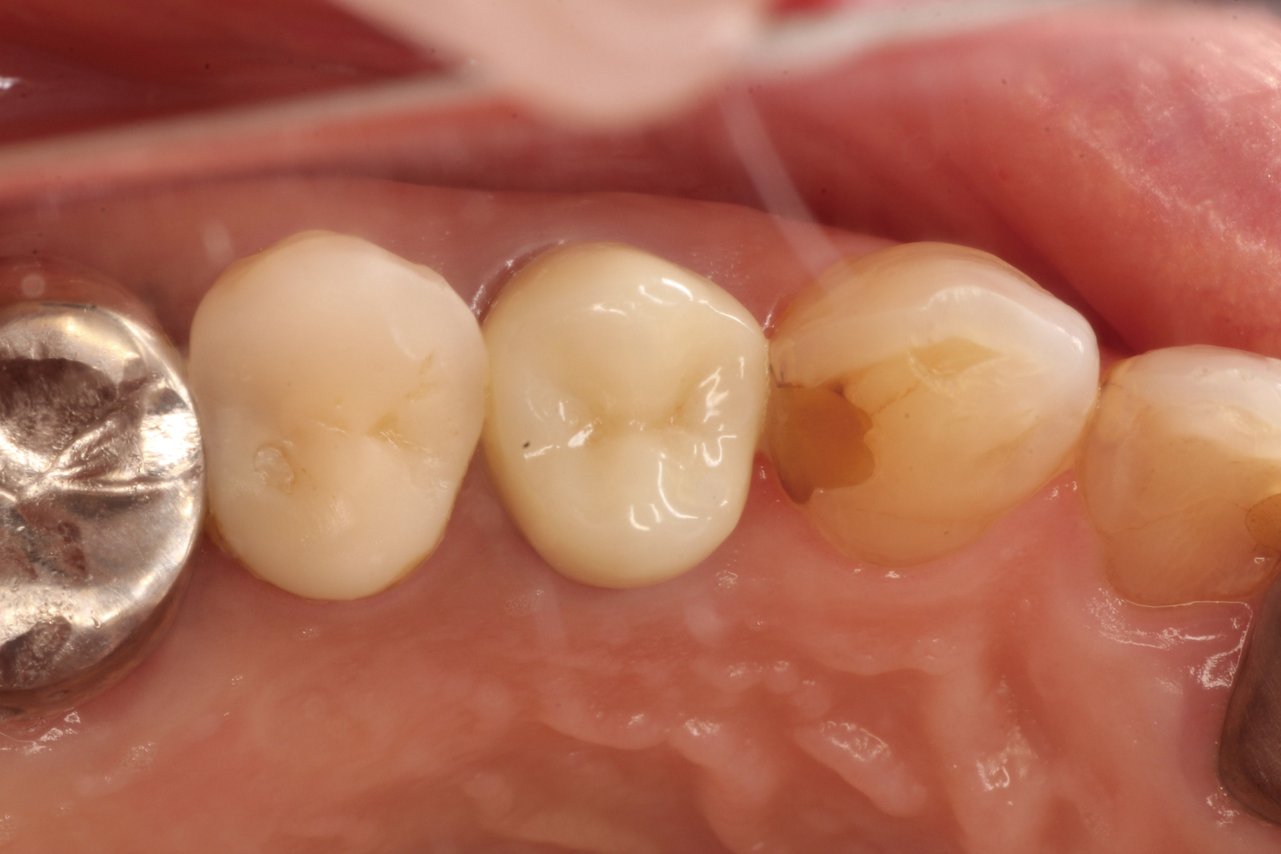 ジルコニアイメージ